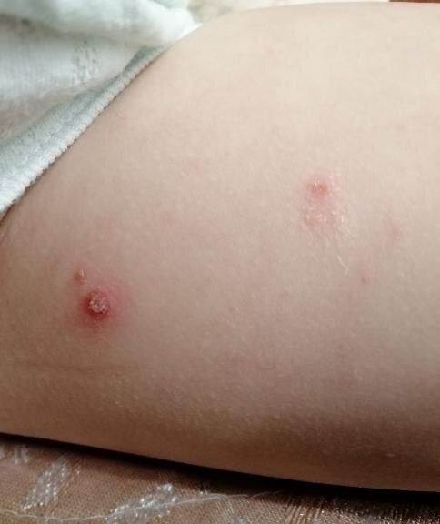 На ноге. На ягодицах штук 15 таких было.