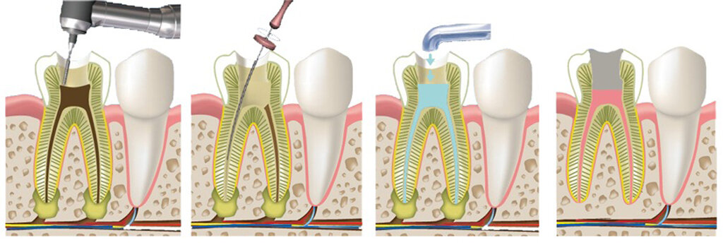 Этапы процедуры депульпации зуба. Фото: dentconsult.ru