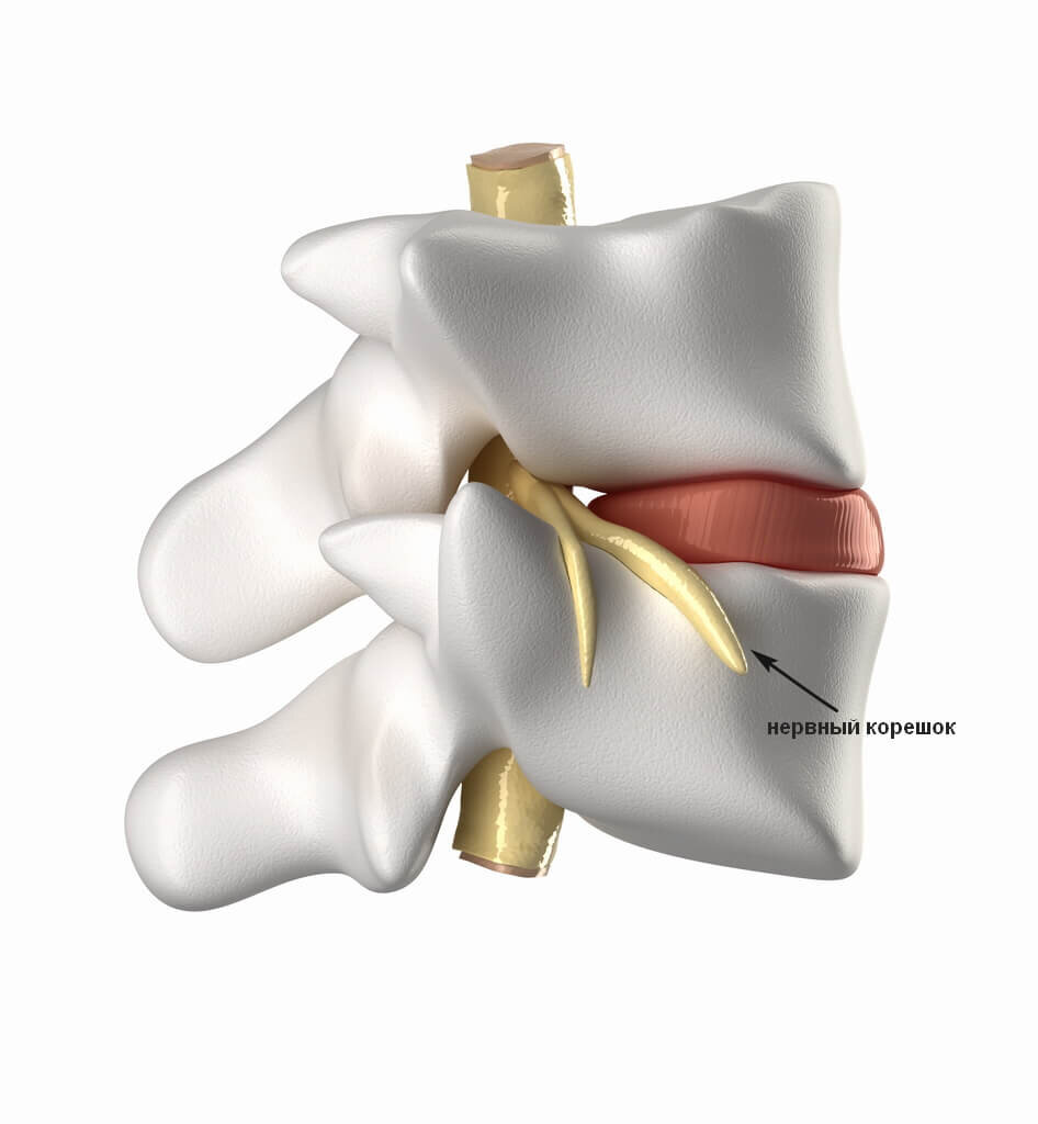 Грыжа поясничного отдела позвоночника