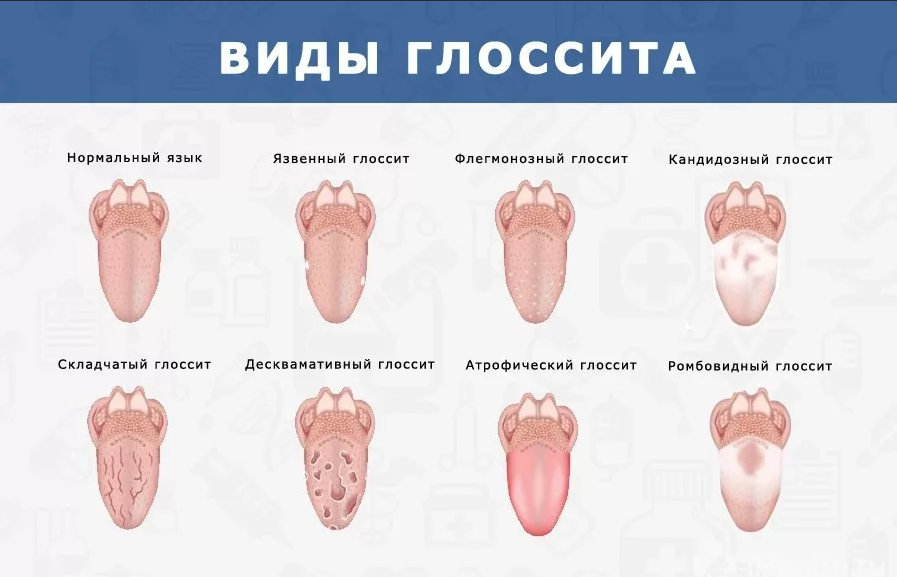 2 формы языка. Десквамативный глоссит языка. Глоссит Гюнтера Миллера. Десквамативный (блуждающий) глоссит.