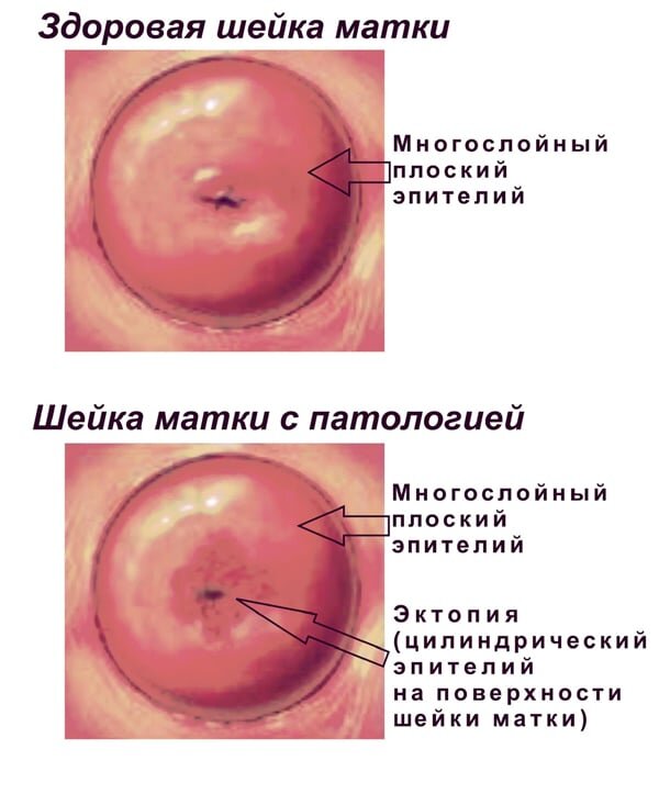 Именно так выглядит эктопия шейки матки - покраснение вокруг наружного зева. У эктопии всегда есть четкие контуры  (это особенно хорошо видно при окрашивании шейки матки раствором Люголя при кольпоскопии)