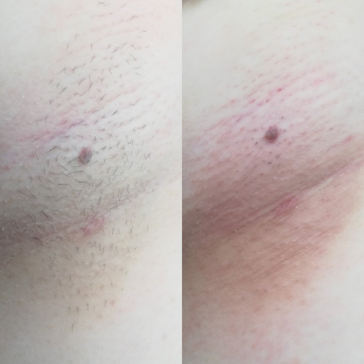 Лазерное удаление тату, пигм, новообр, эпиляция - Аши, косметологическая клиника