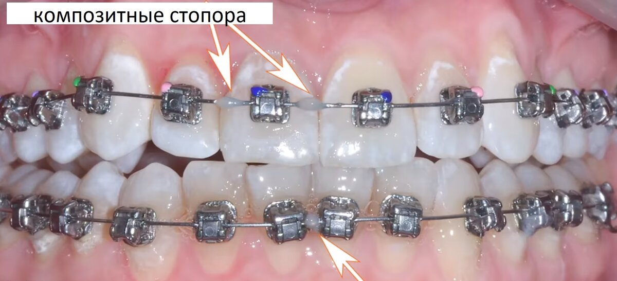 Брекеты царапают щеку: что делать?
