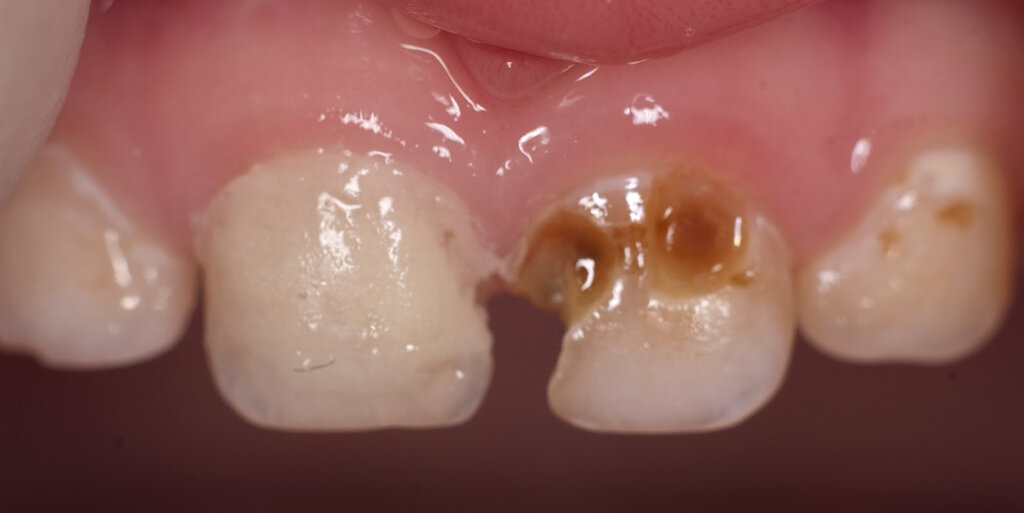 Как выглядит кариес на молочных зубах у ребенка. Фото: dentconsult.ru