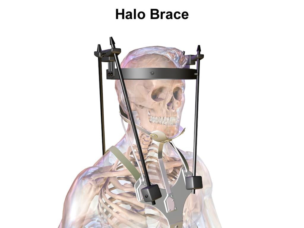 При серьёзных травмах гало-аппарат способен сохранить пациенту коррекцию имеющихся деформаций в шейном отделе