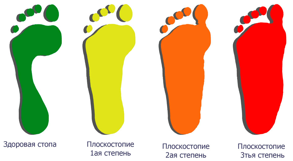 Картинки плоскостопие 3 степени