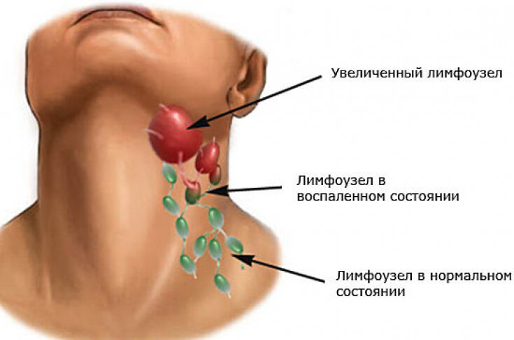 Увеличение лимфатических узлов