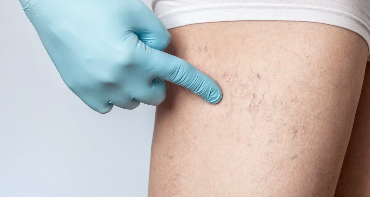 Капиллярная сетка на теле. Фото из открытых источников 