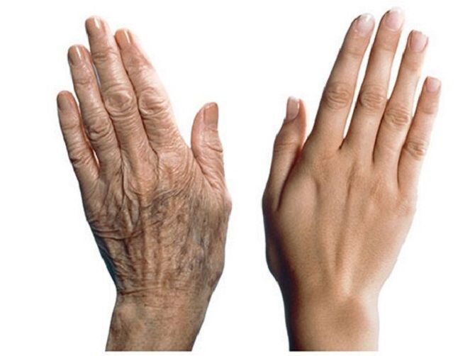 Правду говорят, что возраст женщины выдают её руки. Их дряблая и сухая кожа, появление пигментных пятен  – признаки старения. Морщины на руках появляются раньше, чем на лице.-2