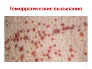 Могут появляться кожные сыпи (кровоизлияния в виде звездочек, пятен, бугорки или волдыри), отечность и высыпания на пальцах.