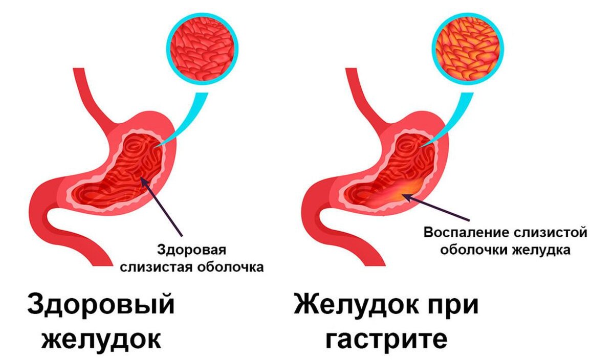 Стул при повышенной кислотности