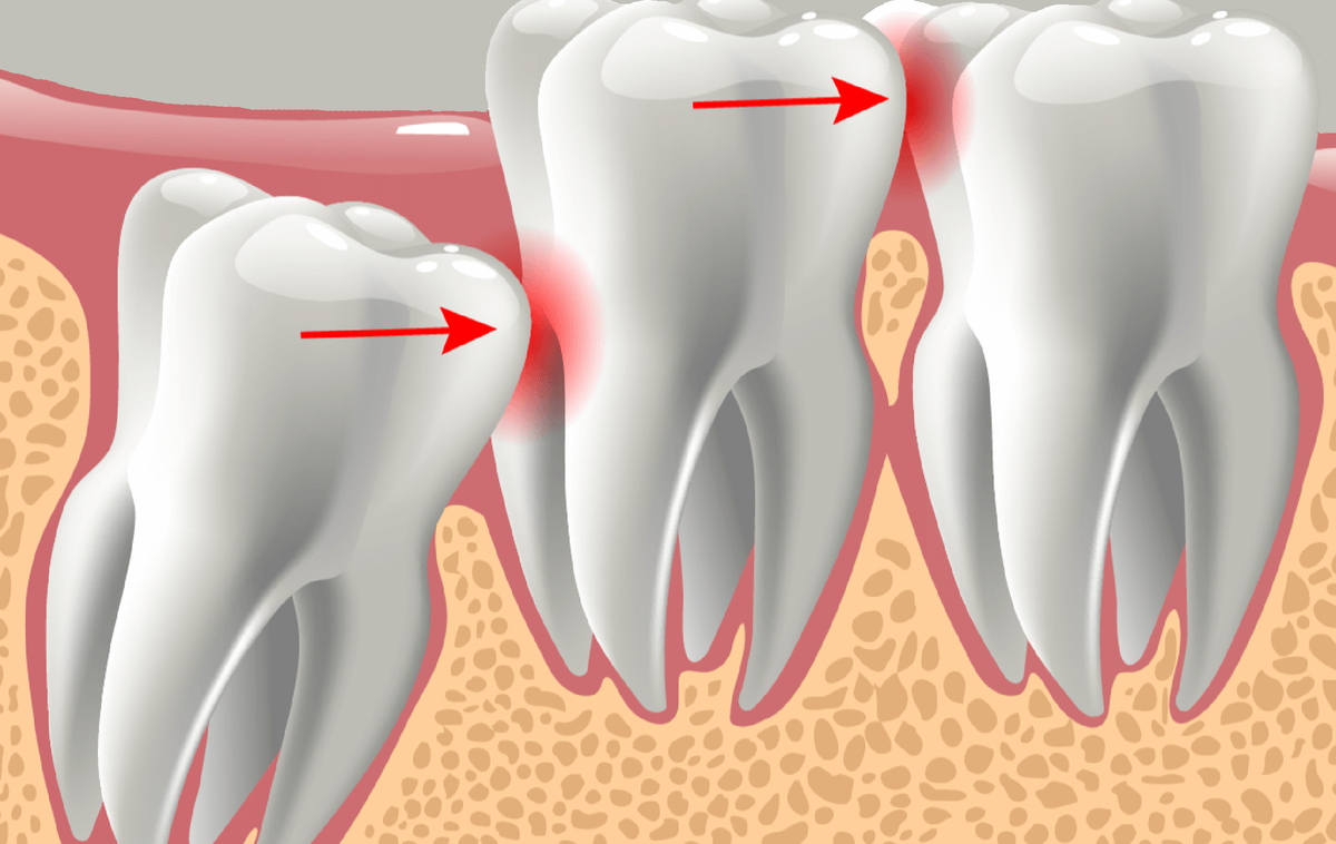 Удаление зуба мудрости взрослому: показания к операции и ее особенности
