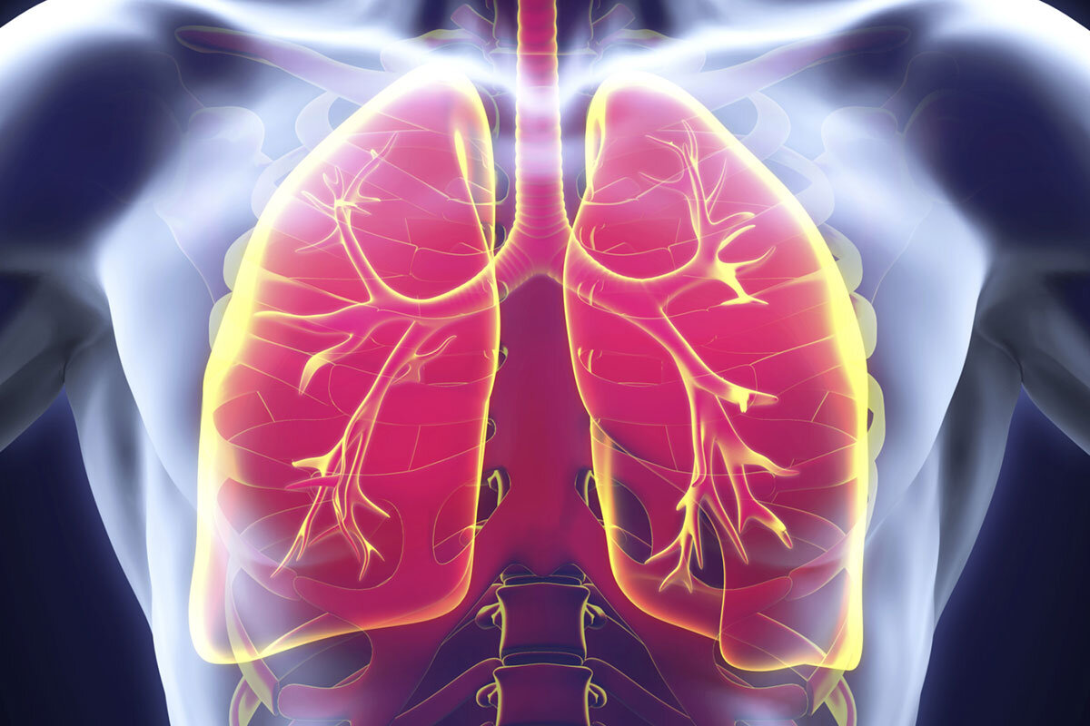 Пневмония: причины, симптомы, лечение воспаления легких