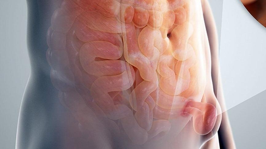 Как-то так это выглядит, только выпавшая часть кишечника обтянута кожей.