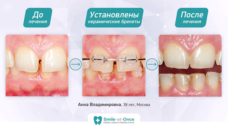 Пациентка не захотела маскировать щель между зубами винирами или коронками и прошла лечение на керамической брекет-системе.