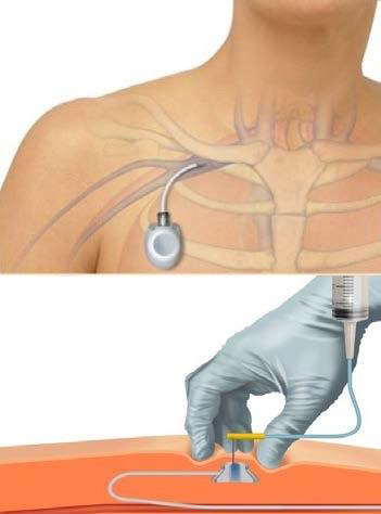 Установка порт-системы