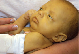 Желтуха новорожденного