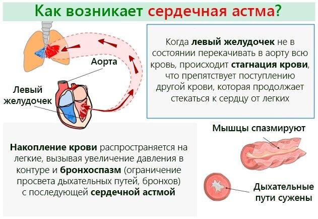 Почему возникает астма: причины и факторы риска