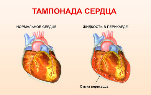 тампонада сердца