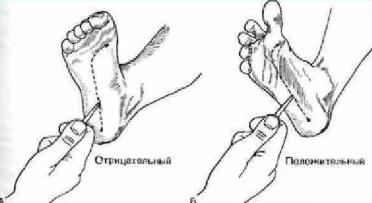 рефлекс Бабинского (фото из открытых источников)