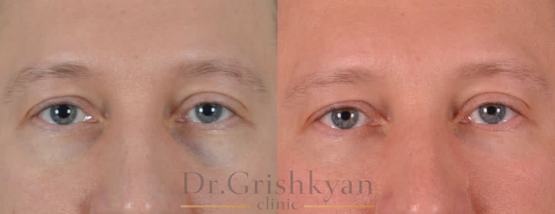 За коррекцией липофилингом обращаются даже мужчины. Не удивительно: операция не оставляет следов и имеет короткий период реабилитации. Фото с сайта Д.Р. Гришкяна. Имеются противопоказания, требуется консультация специалиста