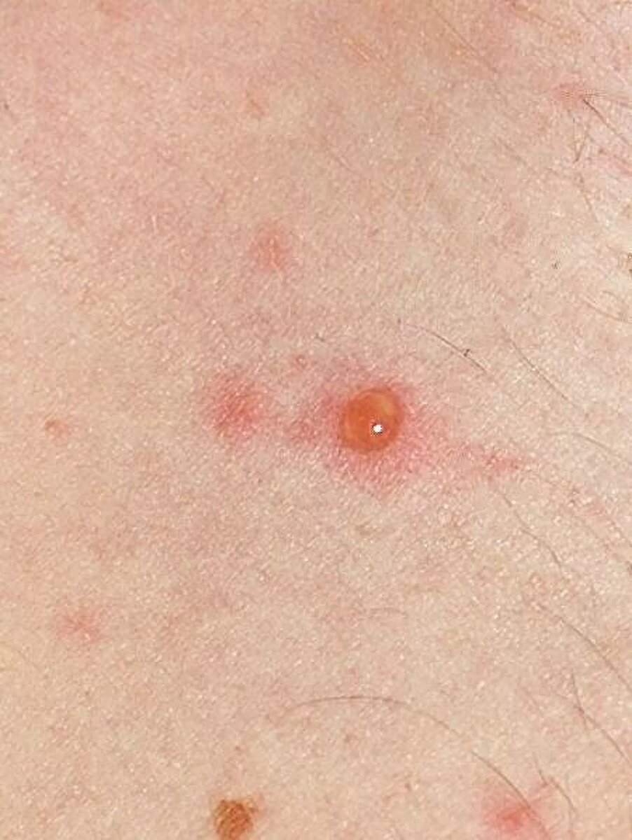 Единичный волдырь, характерный для ранних стадий сыпи