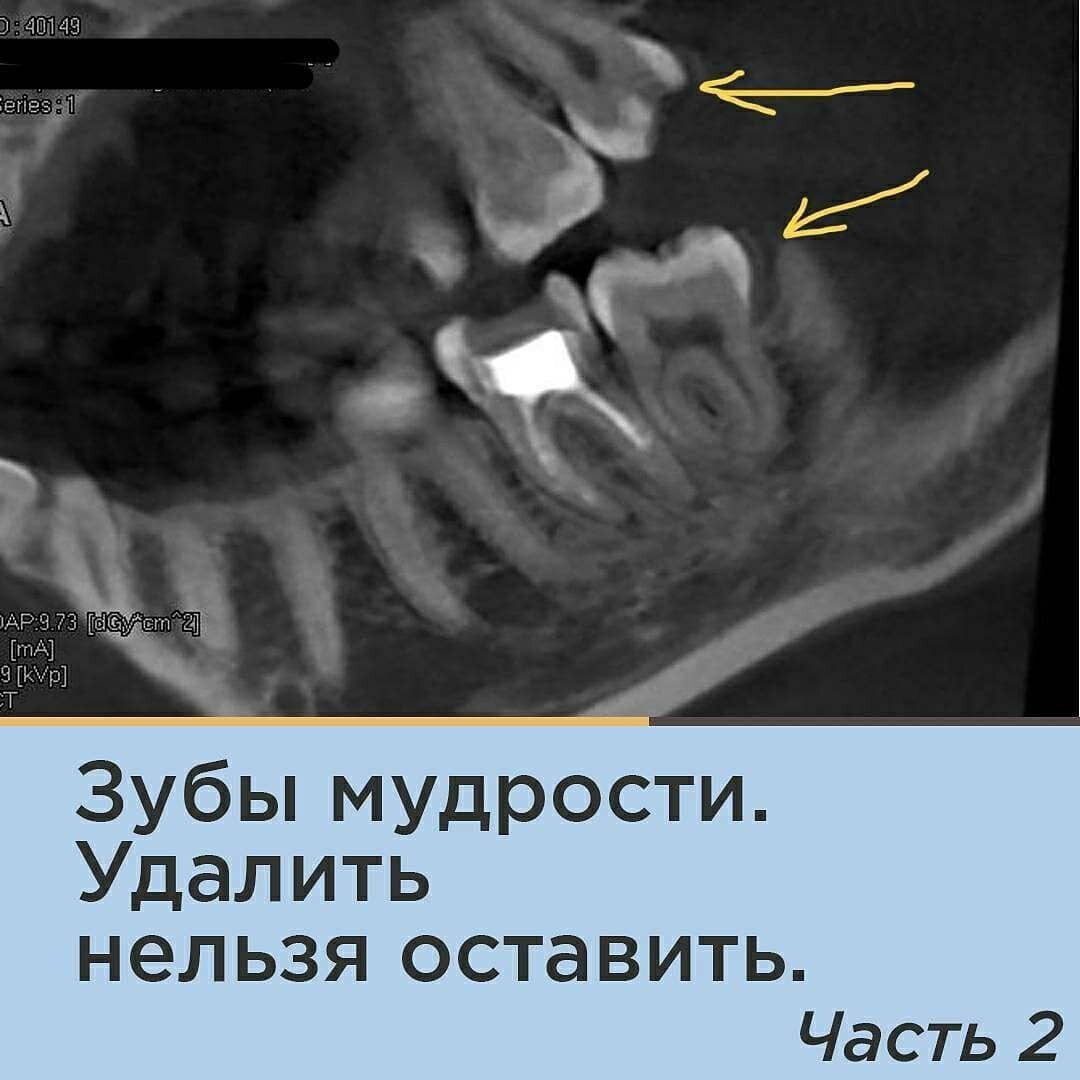 Зубы мудрости: «УДАЛИТЬ НЕЛЬЗЯ ОСТАВИТЬ». Часть 2. | Неочередной стоматолог  | Дзен