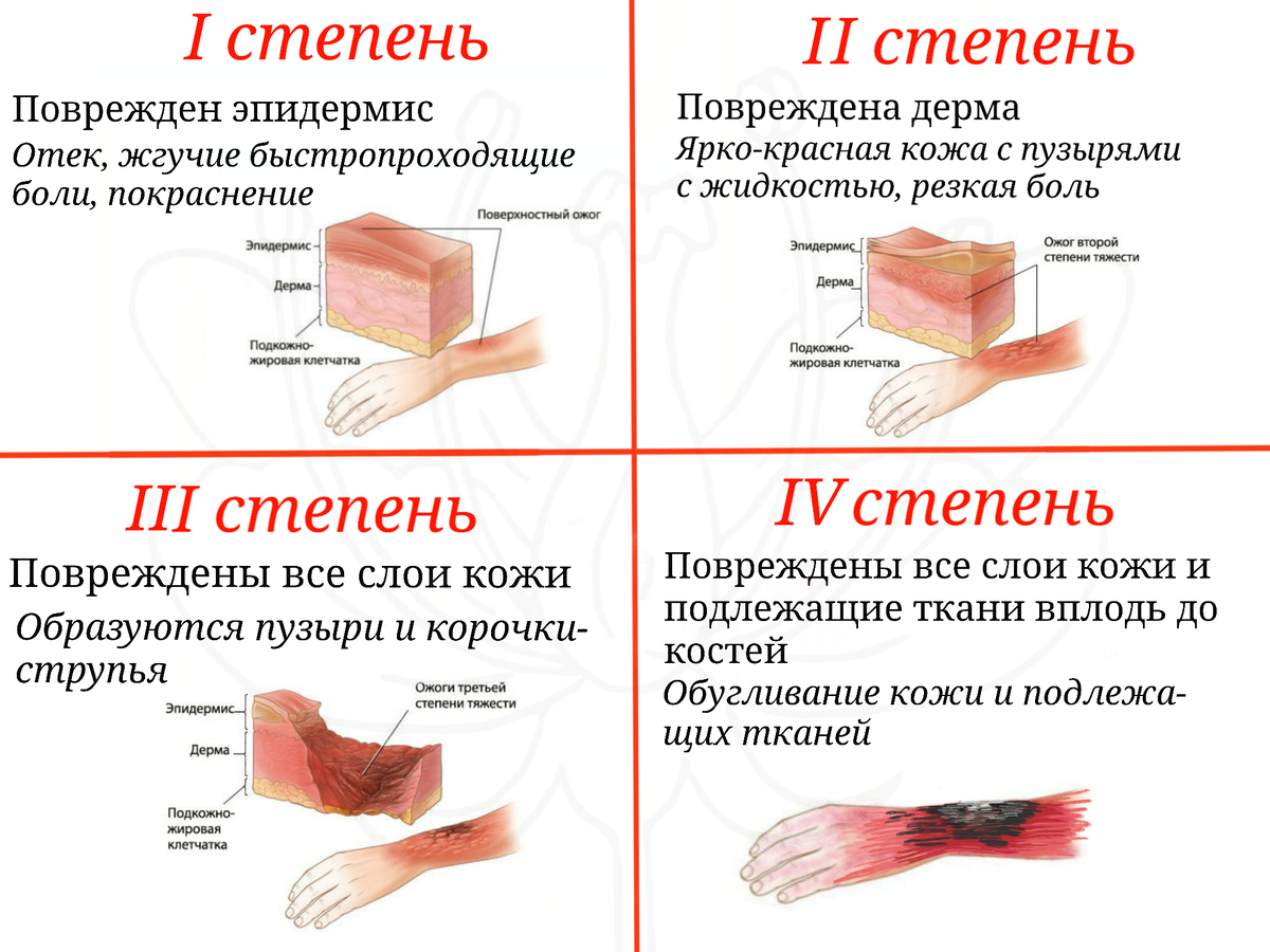 Охарактеризовать степени ожогов. Ожоги первая помощь картинки.