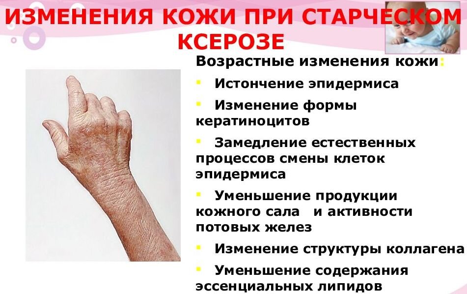 Синдром Шегрена — причины, диагностика и лечение в Астрахани | Болезни | Клиника «Консилиум»