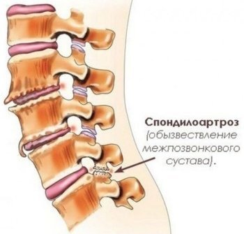 Спондилоартроз 2 степени что это такое. Спондилез с3-с7 позвонков. Спондилез пояснично-крестцового отдела позвоночника. Спондилоартроз th5 - th12. Спондилоартроз грудного отдела позвоночника.