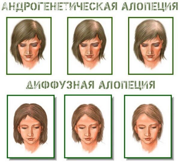 Андрогенная алопеция у женщин лечение фото Диффузная алопеция Магазин Parik-ru Дзен