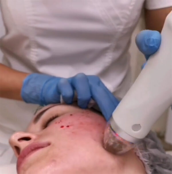 Проведение микроигольчатого РФ-лифтинга