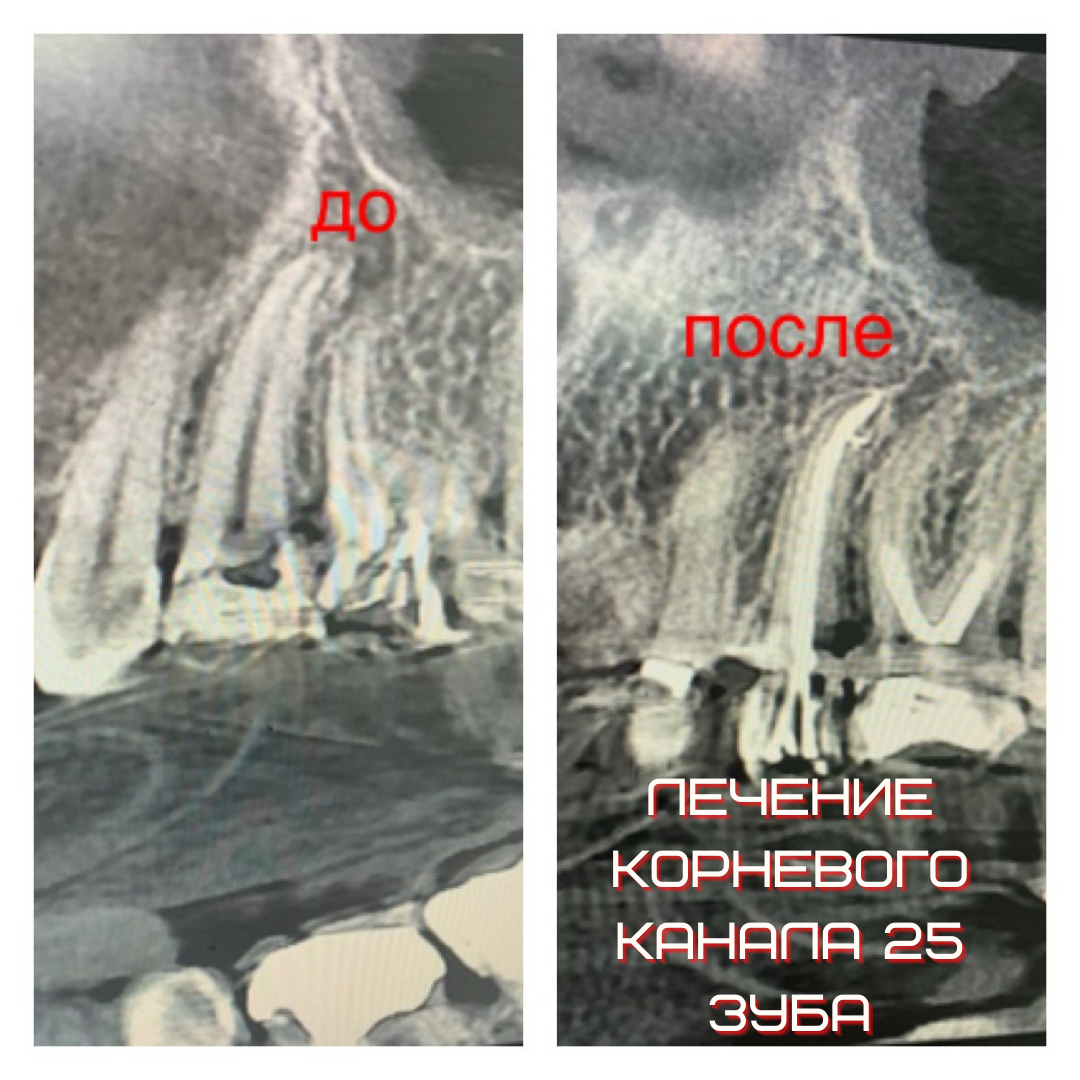 ЛЕЧЕНИЕ КОРНЕВОГО КАНАЛА СИЛЬНО РАЗРУШЕННОГО 26 ЗУБА ‼️”
Жалобы : -на боли -на разрушение - на санация полости рта-на застреваете пищи - на боли от раздражителей и приёма пищи - на сохранение зубов 

Было сделано ✅: -Консультация, фото протокол , обследование 3D рентген ,диагнозы , планы , согласование планов лечение , совместные консультации ортодонта , ортопеда , хирурга -профессиональная гигиена полости рта -лечение канала 25 зуба -лечение кариесов и замена старых пломб -протезирование зубов и дальше будет выпрямление прикуса -контрольные фото протокол -запись в очередь 

По времени 2 часа и продолжительность 2 недели на лечение канала. Материалы : гуттаперчи 02 конус , номер 20 , Ah+ сильно , irm , люксакор и коронка кад кам .

По максимуму стараемся сохранить зубы , даже если очень сильно разрушенные ! 🙂😎

——————————————————
Ваш заботливый доктор Dr. Zaripov .
Мой телефон ☎️ 89190128262 или по ☎️ 8(492)277-99-33 в клинике @laviani-clinic
Наш адрес: г. Владимир, ул. Добросельская 176, здание Бэбибум, 2 этаж
#напоминаниедляпациентов
#интервью #отбеливаниезубов #zoom4 
#обменопыта
#амбассадорпд2021
#профилактика 
#стоматологВладимир #дрзарипов #дрзарипов_отбеливание #отбеливание #philipszoom #консультациястоматолога #знакомство 
#коффердам #изоляция #лечениеканалов