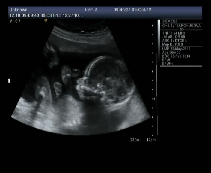 20 недель. Вот таким мы его увидели, мне кажется именно на этом сроке самое интересное УЗИ)) 