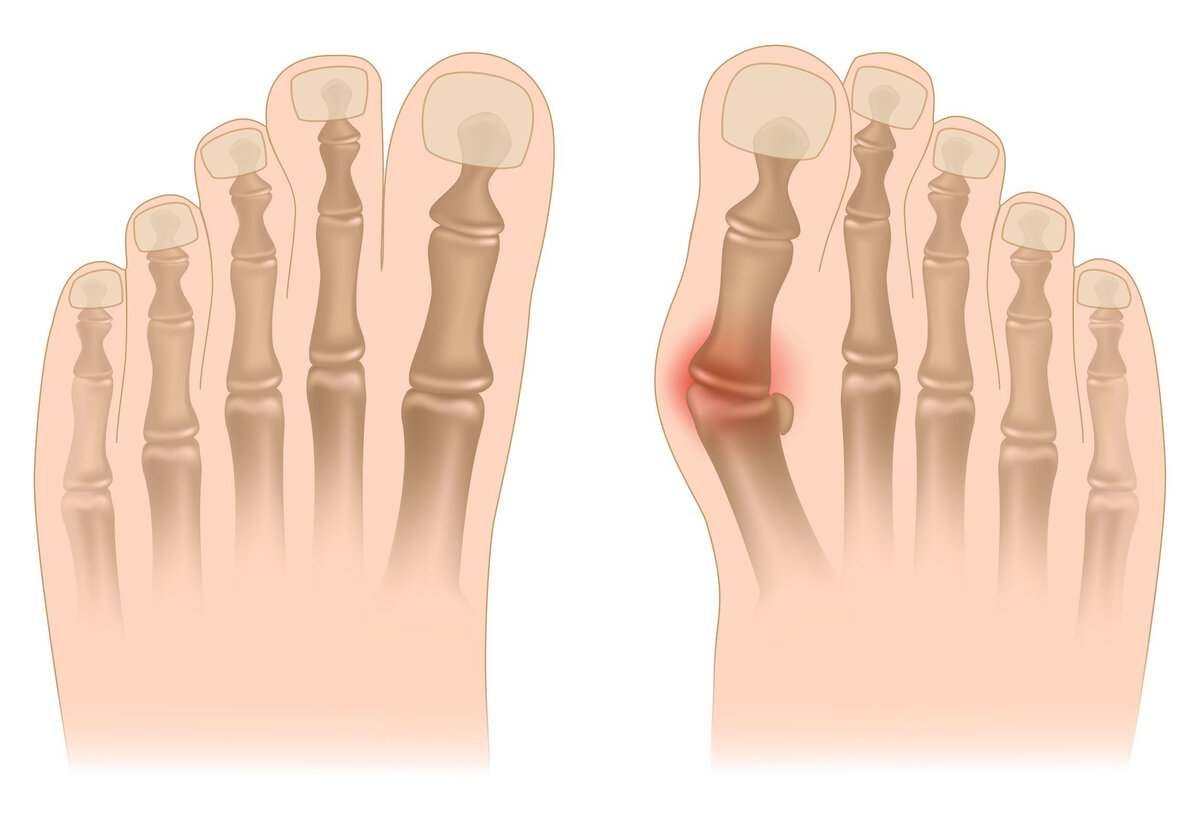 Почему выступает косточка на ноге и что с этим делать — Лайфхакер