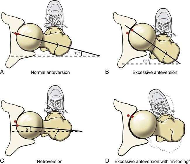 SUPERIOR VIEW SHOWING THE ANGLE OF TORSION OF THE RIGHT HIP. A - THE 15-DEGREE ANTERIOR PROJECTION OF THE FEMORAL HEAD IS CONSIDERED NORMAL ANTEVERSION OF THE HIP. B - EXCESSIVE ANTEVERSION OF THE RIGHT HIP. C - RETROVERSION OF THE HIP. D - A HIP WITH EXCESSIVE ANTEVERSION IS INTERNALLY ROTATED TO IMPROVE HIP JOINT CONGRUITY.