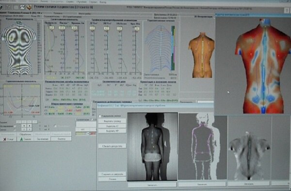Исследование позвоночника на топографе КОМОТ