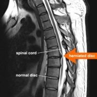 Протрузия межпозвонковых дисков ✔: симптомы, признаки и причины, диагностика и лечение