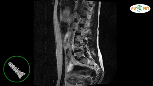 Мрт поясничного отдела ставрополь. Мрт пояснично-крестцового отдела. Анатомия пояснично-крестцового отдела мрт. Мрт поясницы как делают. Мрт пояснично-крестцового отдела пульпозное ядро затемнение.