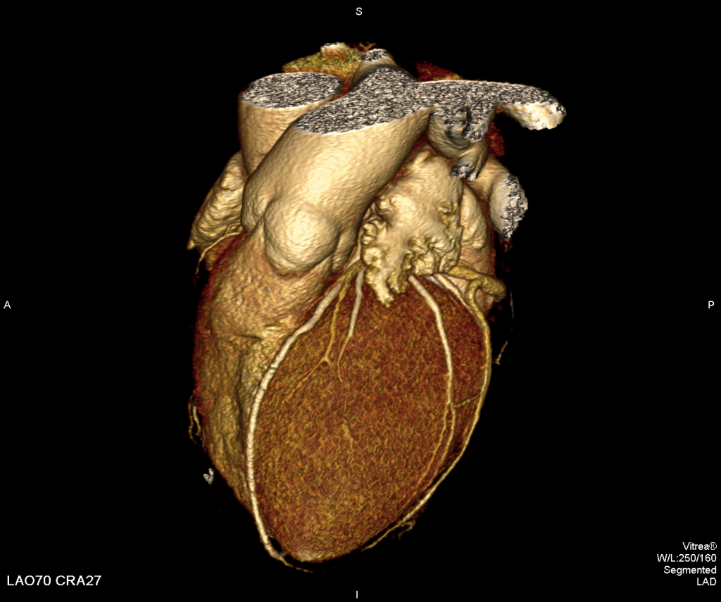 Кт сердца фото