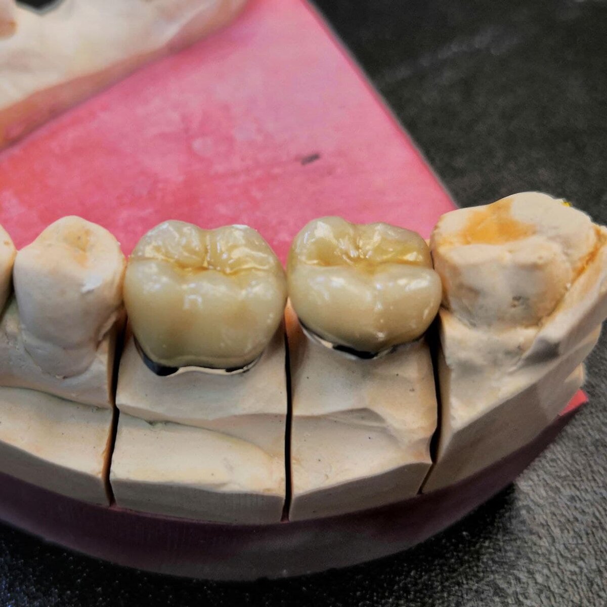 Металлокерамика с круговой гирляндой