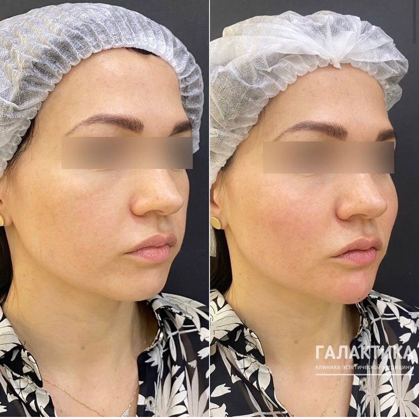 Коррекция средней и нижней трети лица препаратом Radiesse, результат сразу после процедуры.