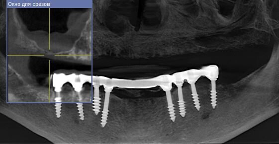 Сильнейшая атрофия кости на в/челюсти, при этом внизу кость сохранена полностью благодаря имплантам установленным много лет назад