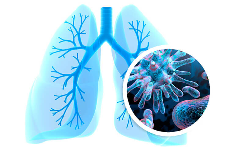 Пневмония – симптомы и лечение