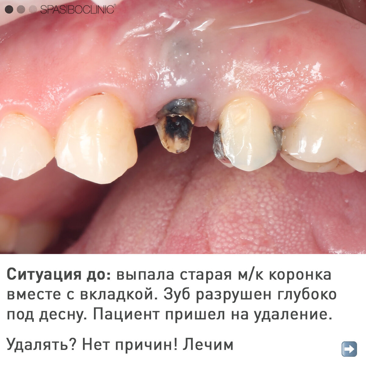 ЛЕЧЕНИЕ "БЕЗНАДЕЖНЫХ" ЗУБОВ | Спасибо.Клиник | Дзен