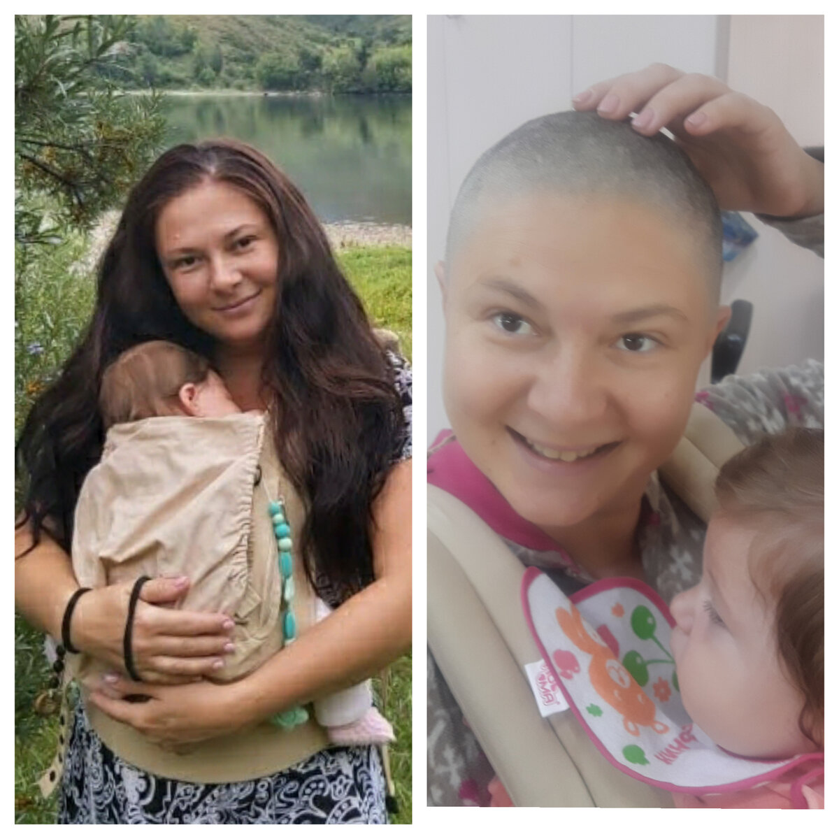 Налысо после родов