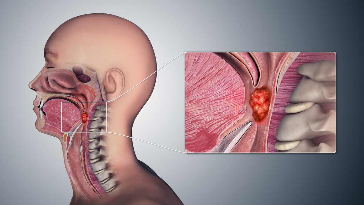 Surgery of primary tracheal tumors
