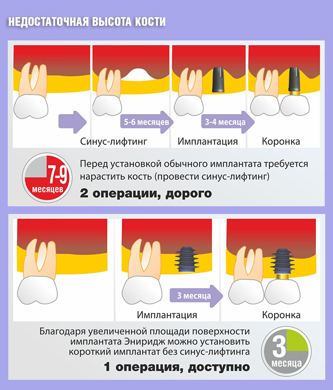 имплант зуба osstem. методика расщепления гребня. остеоинтеграция имплантата к зубу. остеопластика альвеолярного гребня. синус лифтинг в стоматологии что такое.