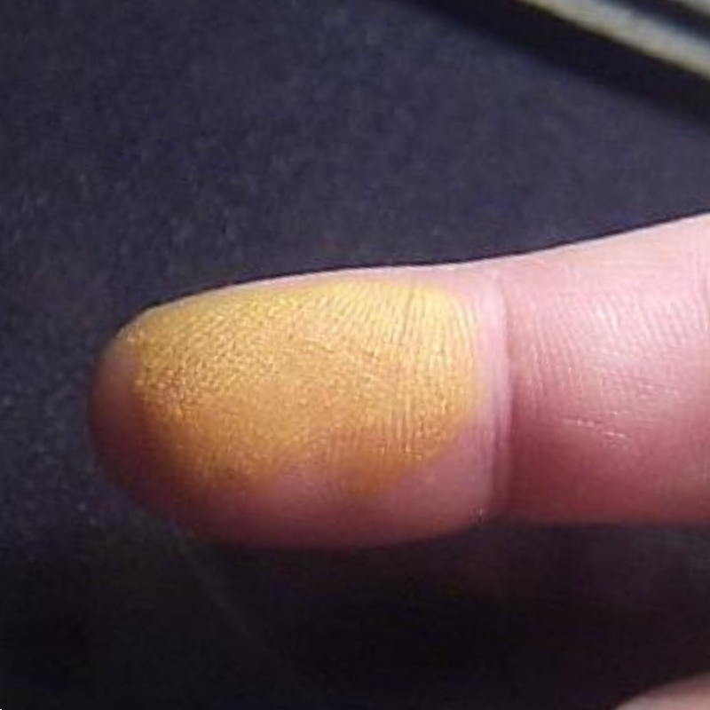 Химический ожог от азотной кислоты