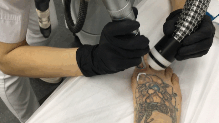 Удаляют тату с пальчика. Больно, но терпимее, чем удаление с крестца